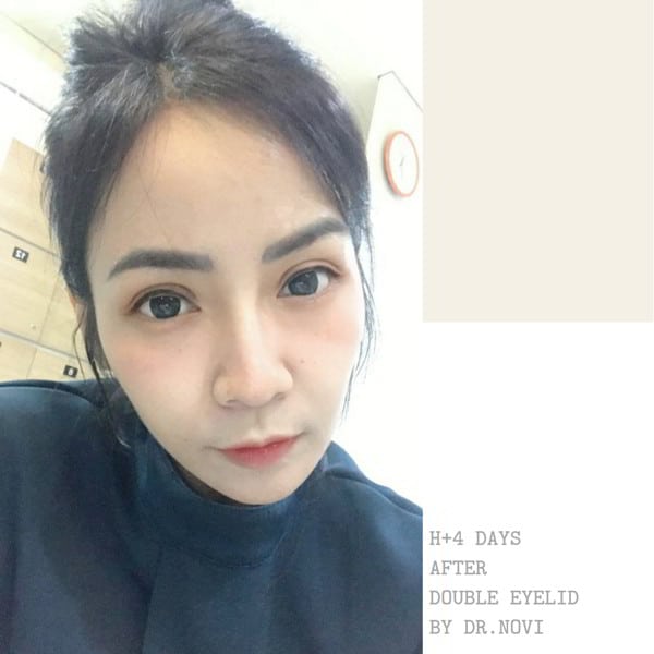 Hasil Sulam Lipatan Mata di VAN Sulam Alis
